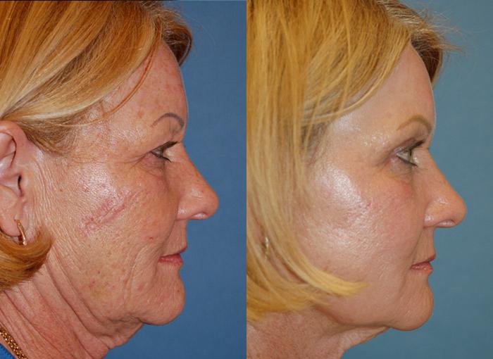 Laser Assisted Weekend Neck Lift Photos Melbourne, FL Patient 28435